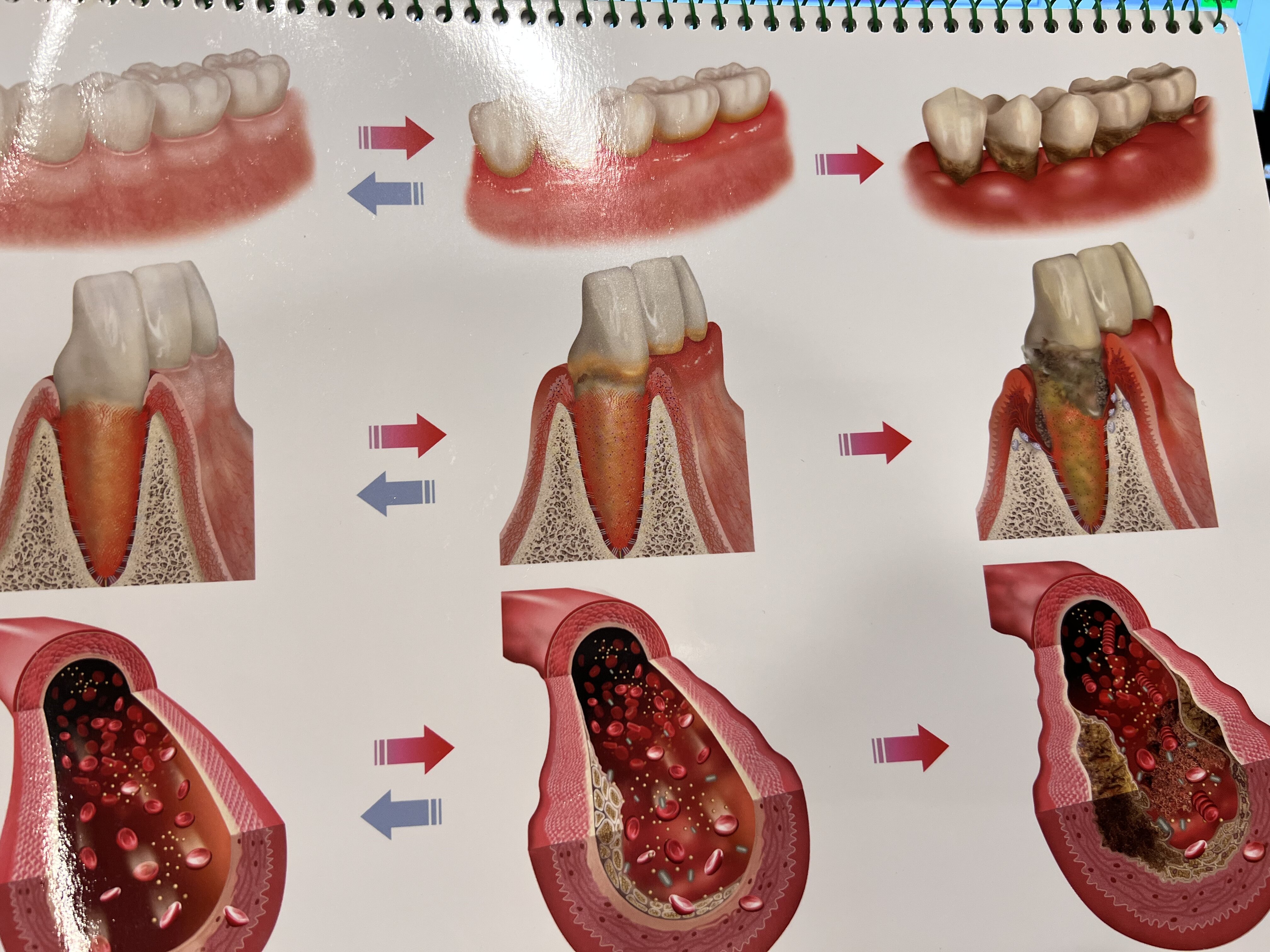 歯周病菌と動脈硬化